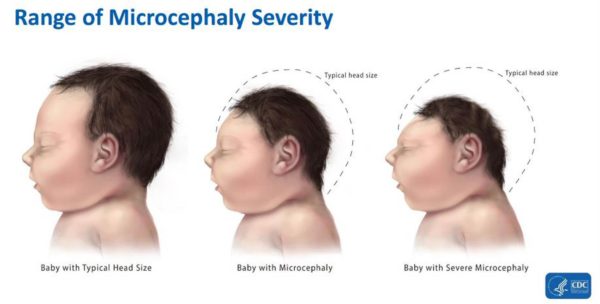 zika-effects-how-to-protect-your-children