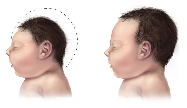 The birth defect most frequently associated with Zika is microcephaly, an incurable condition that causes brain damage and small head size. Read More: http://www.trueactivist.com/its-not-zika-substantial-evidence-suggests-pesticides-really-to-blame-for-birth-defects/