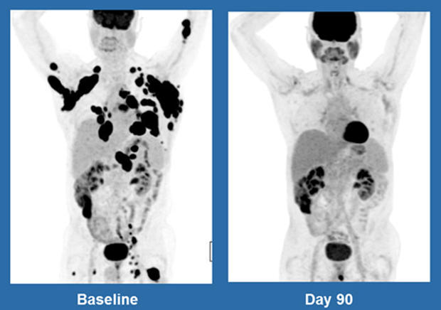 CAR-T cell therapy