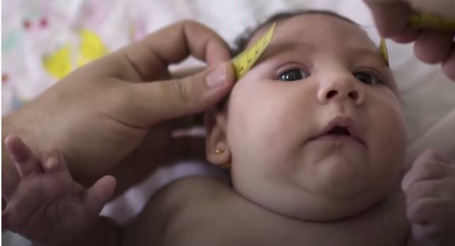 babies with misshapen heads