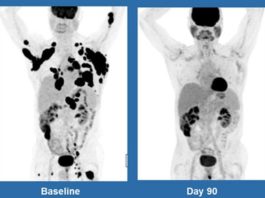 CAR-T-cell-therapy
