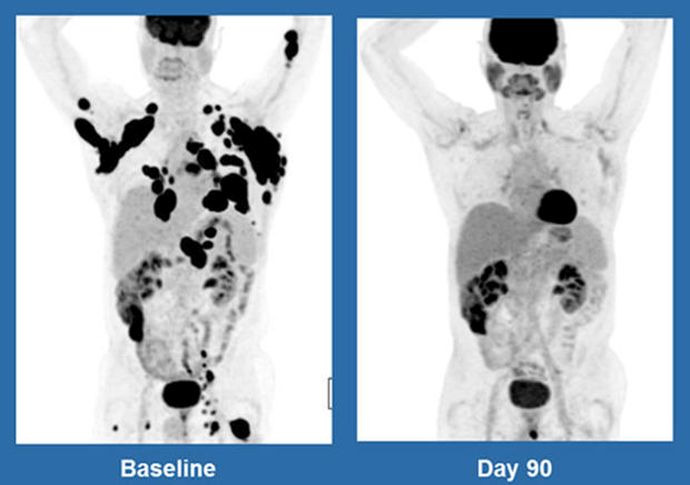 CAR-T-cell-therapy