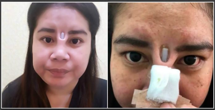 Botched Nose Job Leaves Woman with Silicone Implant Sticking Out of Her ...